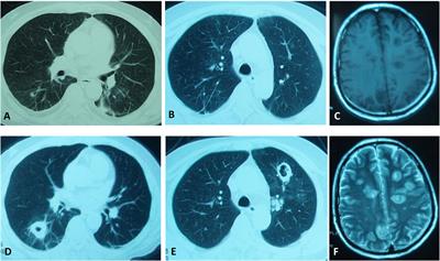 Cushing’s Syndrome With Nocardiosis: A Case Report and a Systematic Review of the Literature